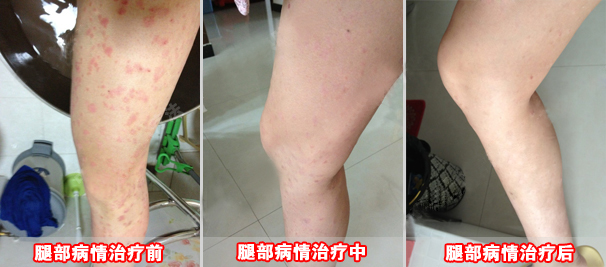 情绪对牛皮癣产生的影响有哪些?