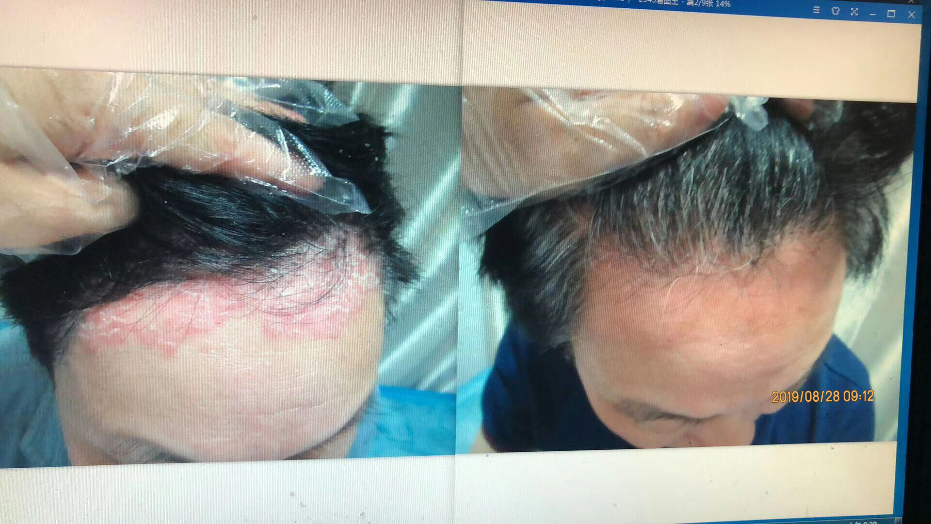 为什么牛皮癣难以治愈，反复发作?