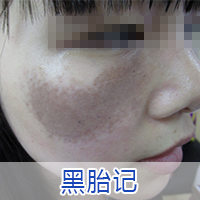 山西治疗胎记的医院哪个好