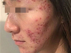 17岁脸上痤疮严重怎么处理,痤疮是由什么引起的
