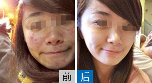 痤疮治疗效果