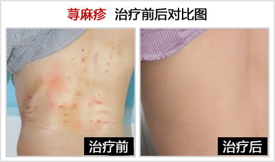 荨麻疹治疗图
