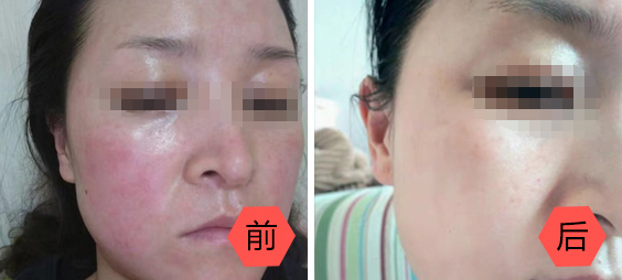 红血丝治疗效果图
