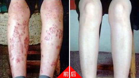 长治皮肤病医院 湿疹
