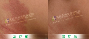忻州皮肤病医院