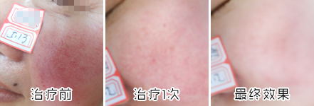 冬季治疗红血丝的最佳时期