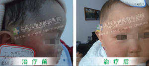 婴儿胎记的最佳治疗时间是什么