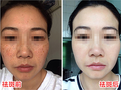 色斑,其实并不完全由年龄决定!如何预防色斑产生?