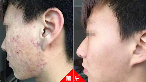 预防痘印与痘疤的形成,有效控制痘痘进一步恶化