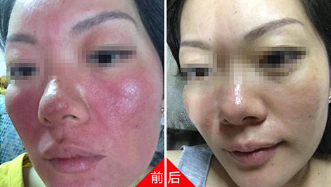  太原医院治疗红血丝会自然消退吗?