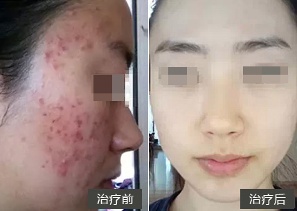 太原脸部长痤疮怎么治疗_脸上痘痘肌肤的医护