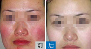 太原有效去除红血丝_解决红血丝烦恼