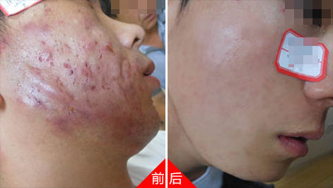 痤疮来袭，我们应该这样战痘
