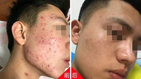  青春痘的最佳去除方法，你知道吗
