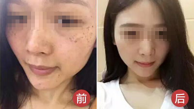 太原皮肤医院激光祛斑会反弹吗？