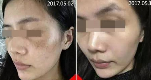 激光祛斑安全吗?真相大揭秘