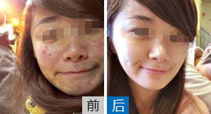 太原闭合性痘痘怎么治疗